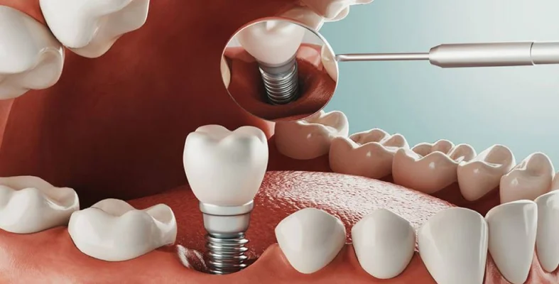 Get A Detailed Comparison Between Dental Implants & Dentures
